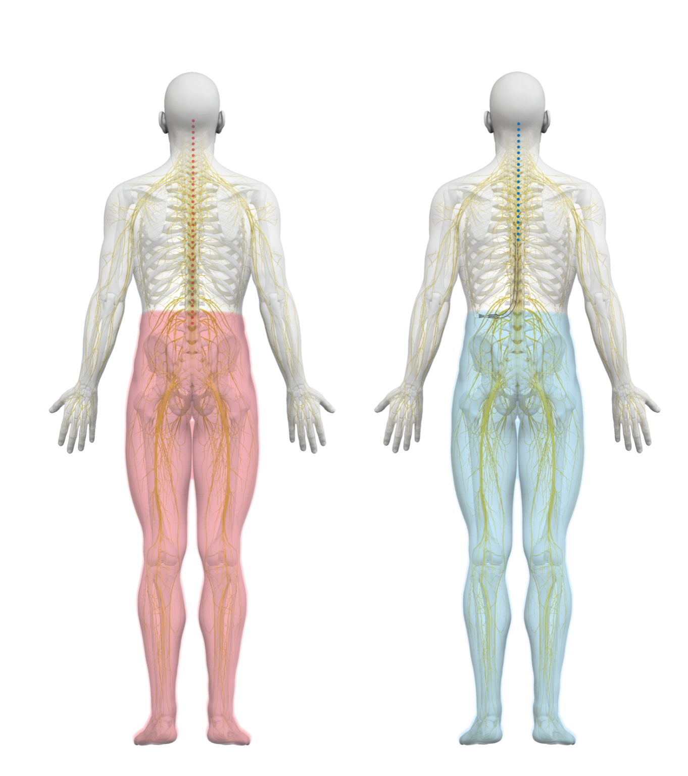 Spinal Cord Stimulator Nalu Medical