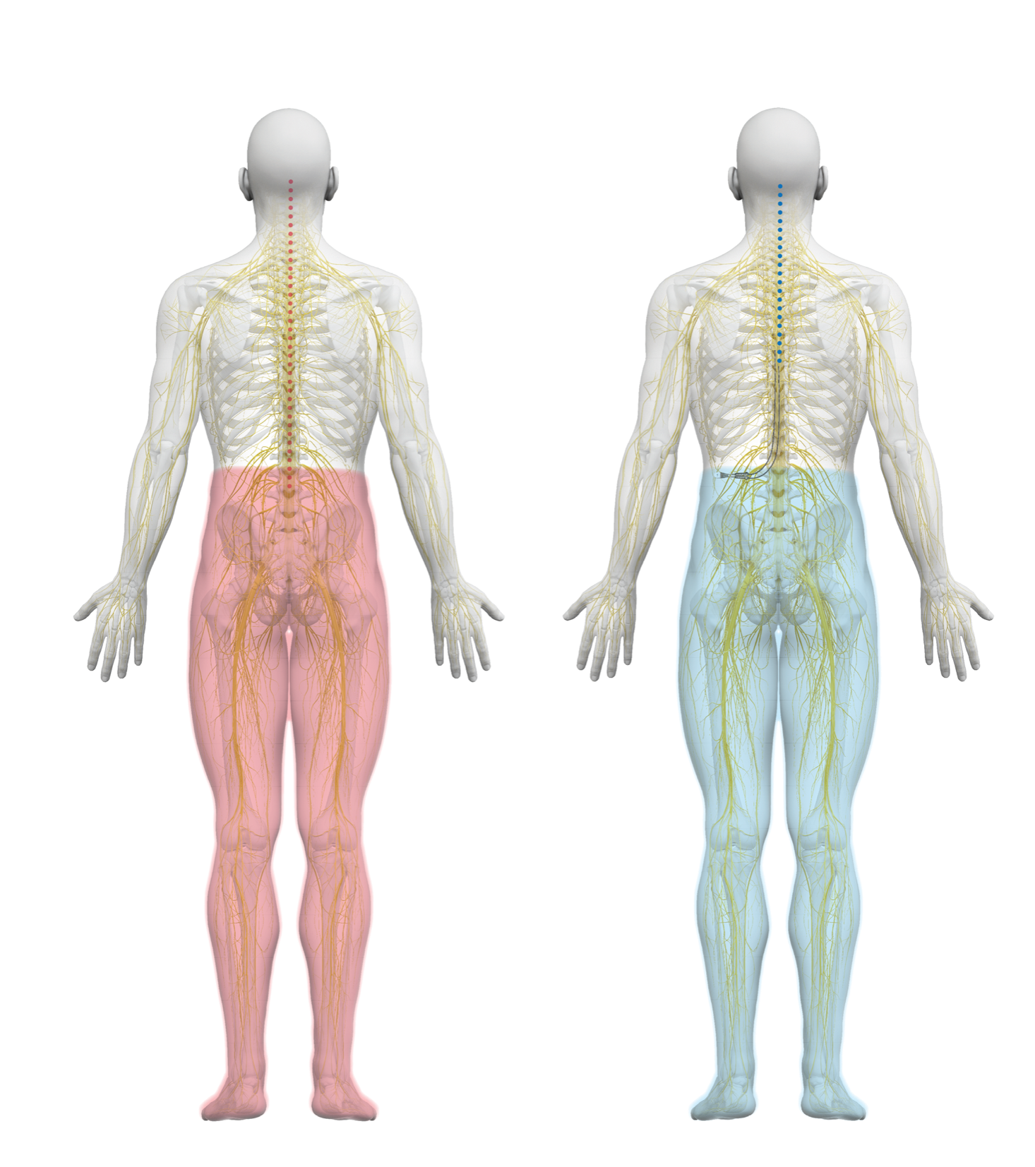 Spinal Cord Stimulator Nalu Medical